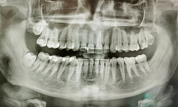 X-ray picture of the teeth of an adult