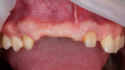 gum without teeth in the region of the central teeth before dental implantation