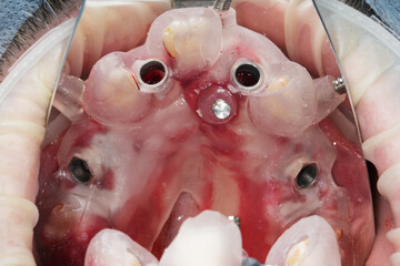 view through the mirror on the surgical dental template for the installation of four implants