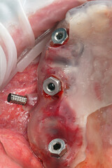 installed three dental implants through a surgical guide for precise placement