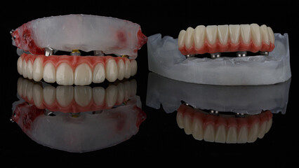 prosthesis of the upper jaw and lower jaw on metal beams on models, taken on black glass with reflection