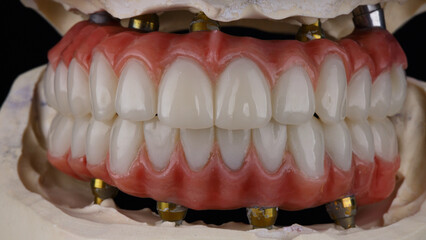 dental prostheses of the upper and lower jaws from zircon and titanium with pink gums on models