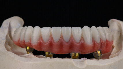 dental prosthesis of the lower jaw from zircon and titanium with a pink gum on a black background