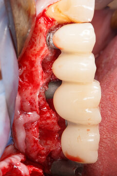 fitting of a temporary dental bridge crowns after implantation