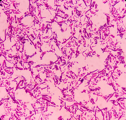 Salmonellosis: microscopic view of gram stained slide from blood agar salmonella colonies, show Salmonella Typhi (S. Typhi) bacteria, disease is referred to as typhoid fever.
