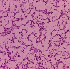 Salmonellosis: microscopic view of gram stained slide from blood agar salmonella colonies, show Salmonella Typhi (S. Typhi) bacteria, disease is referred to as typhoid fever.