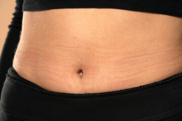 skin indents from underwear on a woman's belly