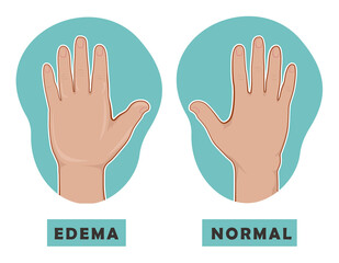 Swollen hand and normal hand. Edema and lymphedema. Vector illustration of the disease before-after.