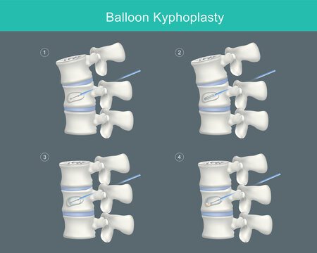 Balloon Kyphoplasty. Medical steps for correcting compression fractures and restoring vertebral body height. Illustration..