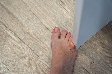 Woman hit furniture with the little toe. Incident at home. Injury of foot little finger