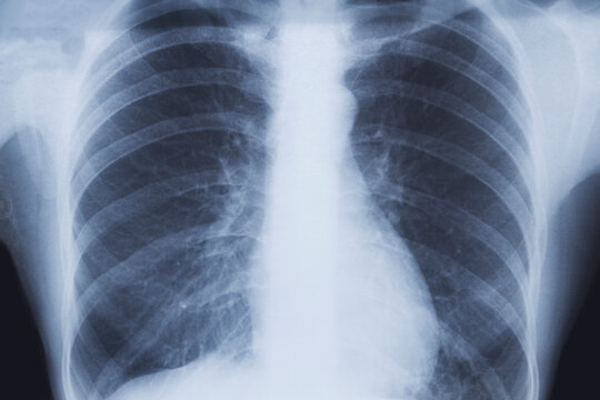 Chest x-ray of a patient with left lower lobe pneumonia. SARS-CoV-2 covid-19 virus infection.