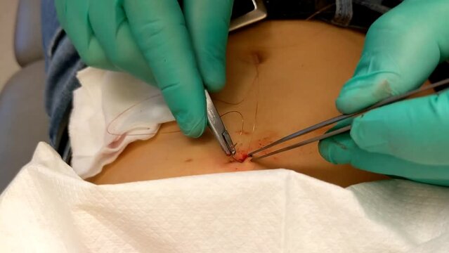 Stitching lesion after benign skin lesion, mole removal.
Fibroepithelial Polyp on Abdomen