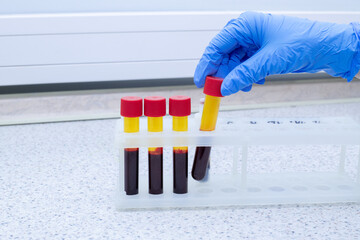 A laboratory medical worker demonstrates a stand with test tubes filled with venous blood for...