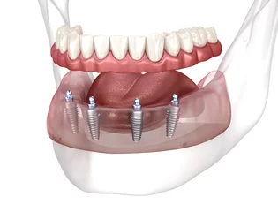 Deurstickers Removable mandibular prosthesis All on 4 system supported by implants. Medically accurate 3D illustration of human teeth and dentures concept © Alex Mit