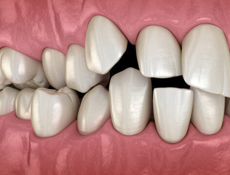Overcrowded teeth, abnormal dental occlusion. Medically accurate tooth 3D illustration