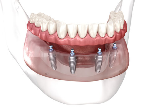 Removable mandibular prosthesis All on 4 system supported by implants. Medically accurate 3D illustration of human teeth and dentures concept