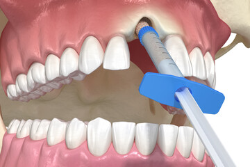 Bone grafting augmentation, socket preservation, tooth implantation. Medically accurate 3D illustration. - obrazy, fototapety, plakaty
