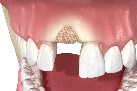 Augmentation Surgery - Adding bone after tooth extraction. 3D illustration