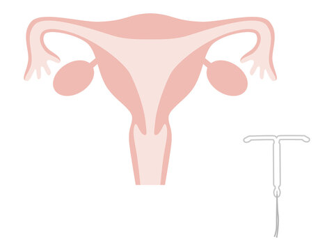 子宮内避妊システム（IUS）と装着前の子宮