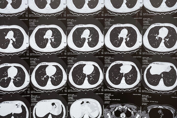 Computed tomography of the lungs, selective focus.  Chest CT scan with signs of bronchiolitis,...