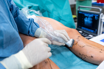 Process of varicose vein surgery in hospital, operating room, vein sealing, venous vascular surgery concept - obrazy, fototapety, plakaty