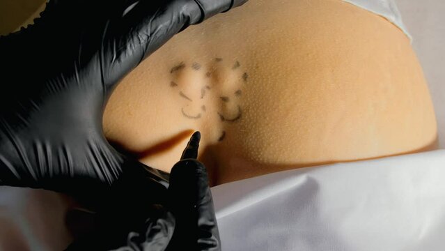 Fracture of the coccyx of the spine. External medical exam by a doctor. Gloved hands show trauma. The sacrum and coccyx protrude and are clearly visible. Female patient.