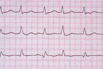 Naklejka premium Close Up Echocardiograph test report (ECG) showing abnormal heart rhythm.