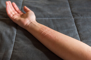 Detalle del brazo de una mujer que padece una afección de la piel llamada dermografismo,...