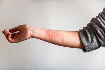 Detalle del brazo de una mujer que padece una afección de la piel llamada dermografismo, dermatografismo o "escritura en la piel", un tipo de urticaria común y benigna.