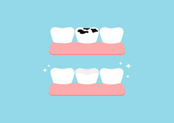 Teeth before and after multiple caries in gym dental icon set isolated. Teeth dentistry restoration with porcelain sealant in cavity treatment concept. Flat cartoon clip art vector illustration.