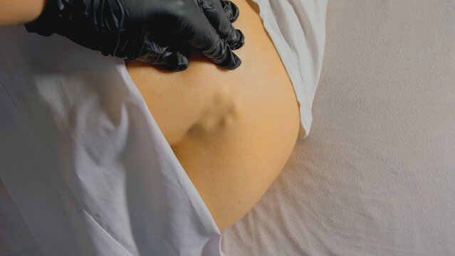 Fracture of the coccyx of the spine. External medical exam by a doctor. Gloved hands show trauma. The sacrum and coccyx protrude and are clearly visible.