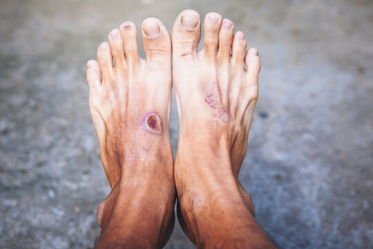 wound of beginning diabetic foot compare with normal foot. Selected focus