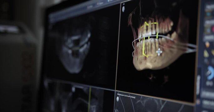 MRI of the jaw in a modern dental clinic. MRI image on a patient's x-ray computer screen. Diagnostic medical equipment in modern dentistry