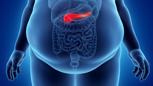 3d rendered illustration of an obese mans pancreas
