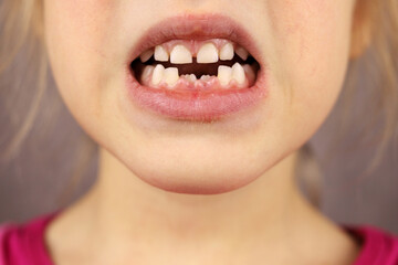 child's mouth without two front teeth, loss of baby teeth