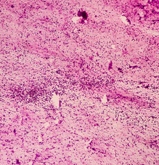 Mediastinal mass(CT guided FNA): Microscopic image of thymoma, a tumor of thymic gland, show necrotic material admixed with lymphocytes, myasthenia gravis.
