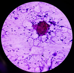 Breast lump(biopsy): Fat necrosis, injury of fatty tissue, show fragments of fatty tissue, foamy...