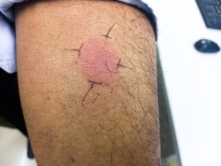 Closeup view photography of old male arm with red spot reaction to conducting Mantoux test after 72...
