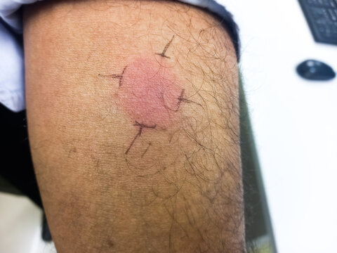 Closeup view photography of old male arm with red spot reaction to conducting Mantoux test after 72 hours from injection, tuberculin test, MT test, TB skin test.