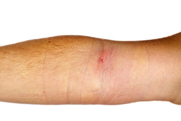 Phlebitis on hand isolated on a white