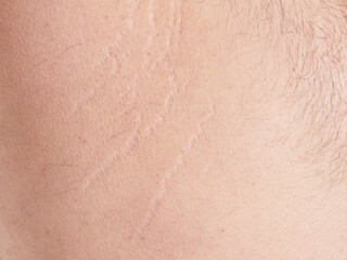 Stretch marks on the torso of a middle aged man, no faces shown, macro photography, extreme close up look
