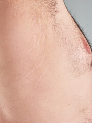 Stretch marks on the torso of a middle aged man, no faces shown, vertical image