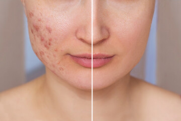Cropped shot of a young woman's face before and after acne treatment on the face. Pimples, red...