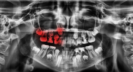 Panoramic x-ray image of teeth