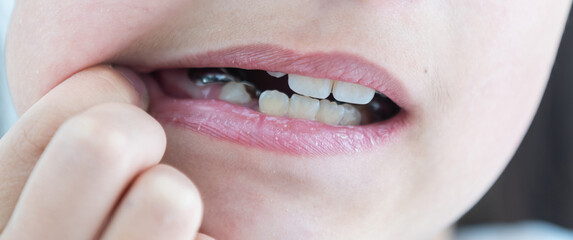 little girl with a plate on her teeth