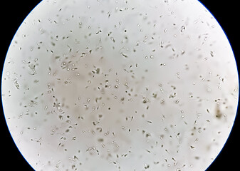 Photomicrograph of Semen analysis show normal count of sperm depend on quantity and morphology....