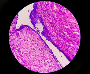 Ovarian cyst, Serous cyst adenofibroma, relatively rare benign ovarian tumor, photo under light...