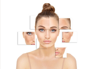 Dark spots, freckles,hyperpigmentation(melasma or chloasma),concept- skin lightening, skin...