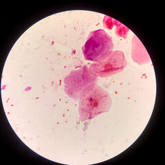 Bacteria cell Gram neagative bacilli with capsule.Sample sputum in Gram stain method.