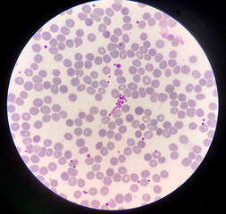 Platelet clumping in smear CBC on red blood cells background.